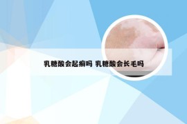乳糖酸会起癣吗 乳糖酸会长毛吗