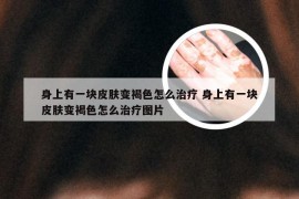 身上有一块皮肤变褐色怎么治疗 身上有一块皮肤变褐色怎么治疗图片