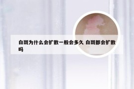 白斑为什么会扩散一般会多久 白斑都会扩散吗