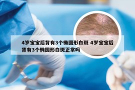 4岁宝宝后背有3个椭圆形白斑 4岁宝宝后背有3个椭圆形白斑正常吗
