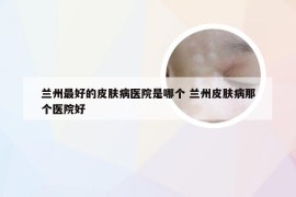 兰州最好的皮肤病医院是哪个 兰州皮肤病那个医院好