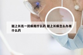 腿上长出一团癣用什么药 腿上长癣怎么办用什么药