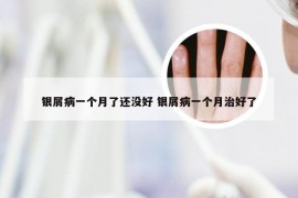 银屑病一个月了还没好 银屑病一个月治好了