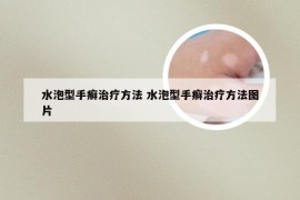 水泡型手癣治疗方法 水泡型手癣治疗方法图片