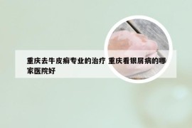 重庆去牛皮癣专业的治疗 重庆看银屑病的哪家医院好