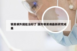 银屑病外国能治好了 国外银屑病最新研究成果