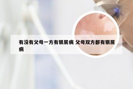 有没有父母一方有银屑病 父母双方都有银屑病