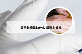 颈后长癣是缺什么 后颈上长癣