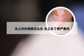 头上长的像癣怎么办 头上长了癣严重吗