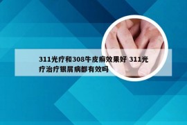 311光疗和308牛皮癣效果好 311光疗治疗银屑病都有效吗