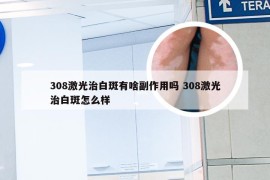 308激光治白斑有啥副作用吗 308激光治白斑怎么样