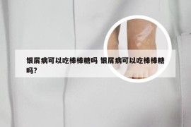 银屑病可以吃棒棒糖吗 银屑病可以吃棒棒糖吗?