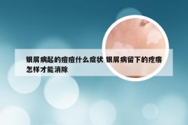 银屑病起的痘痘什么症状 银屑病留下的疙瘩怎样才能消除
