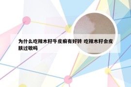 为什么吃辣木籽牛皮癣有好转 吃辣木籽会皮肤过敏吗