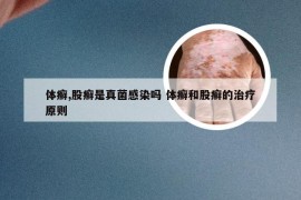 体癣,股癣是真菌感染吗 体癣和股癣的治疗原则