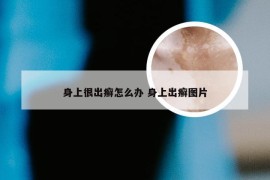 身上很出癣怎么办 身上出癣图片