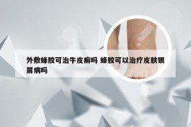 外敷蜂胶可治牛皮癣吗 蜂胶可以治疗皮肤银屑病吗