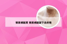 银屑病腿窝 银屑病腿部下去的慢