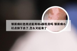 银屑病红色斑点能用维a酸乳膏吗 银屑病小红点抹下去了,怎么又起来了