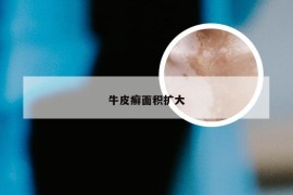 牛皮癣面积扩大