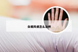 白癜风病怎么治啊