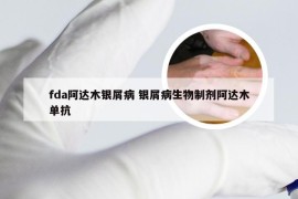 fda阿达木银屑病 银屑病生物制剂阿达木单抗