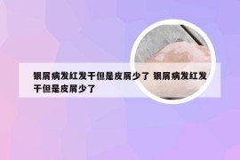 银屑病发红发干但是皮屑少了 银屑病发红发干但是皮屑少了