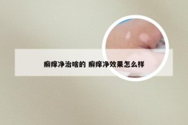 癣痒净治啥的 癣痒净效果怎么样