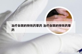 治疗白斑的特效药草药 治疗白斑的特效药草药