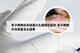 鼻子两侧长白斑是什么原因引起的 鼻子两侧长白斑是怎么回事