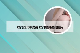 肛门口长牛皮癣 肛门银屑病的图片