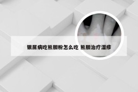 银屑病吃熊胆粉怎么吃 熊胆治疗湿疹