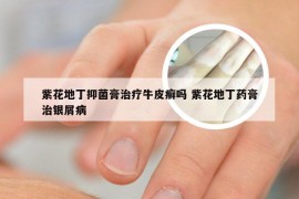 紫花地丁抑菌膏治疗牛皮癣吗 紫花地丁药膏治银屑病