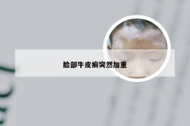 脸部牛皮癣突然加重