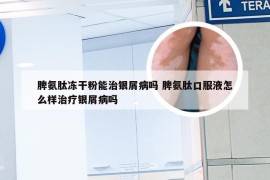 脾氨肽冻干粉能治银屑病吗 脾氨肽口服液怎么样治疗银屑病吗