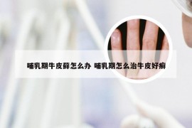 哺乳期牛皮藓怎么办 哺乳期怎么治牛皮好癣