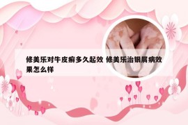 修美乐对牛皮癣多久起效 修美乐治银屑病效果怎么样