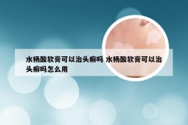 水杨酸软膏可以治头癣吗 水杨酸软膏可以治头癣吗怎么用