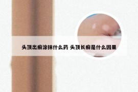 头顶出癣涂抹什么药 头顶长癣是什么因果
