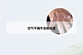 空气干燥牛皮癣加重