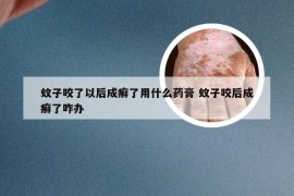 蚊子咬了以后成癣了用什么药膏 蚊子咬后成癣了咋办
