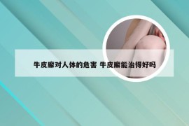 牛皮廨对人体的危害 牛皮廨能治得好吗