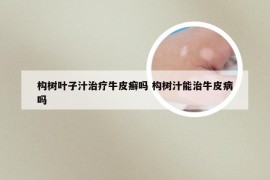 构树叶子汁治疗牛皮癣吗 构树汁能治牛皮病吗