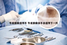 牛皮肤癣遗传不 牛皮肤癣会不会遗传下一代