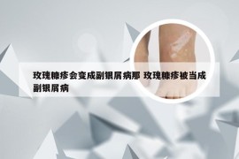 玫瑰糠疹会变成副银屑病那 玫瑰糠疹被当成副银屑病