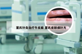 董氏针灸治疗牛皮廨 董氏皮肤病针方