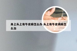 身上头上有牛皮癣怎么办 头上有牛皮病癣怎么治