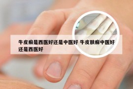 牛皮癣是西医好还是中医好 牛皮肤癣中医好还是西医好