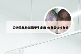 公务员体检灰指甲牛皮癣 公务员体检有癣