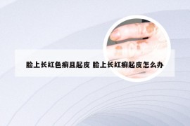 脸上长红色癣且起皮 脸上长红癣起皮怎么办
